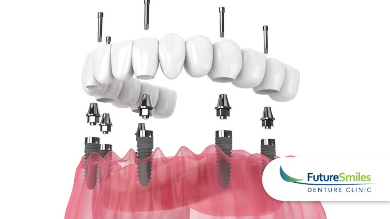 When Denture Implants Aren't the Right Choice